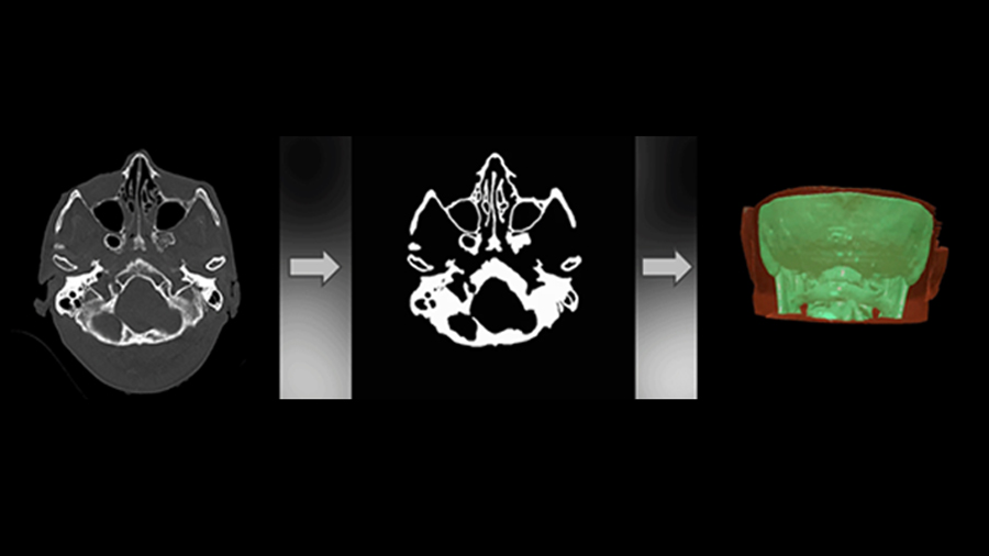 Inteligencia artificial para cirugías más seguras en la cabeza