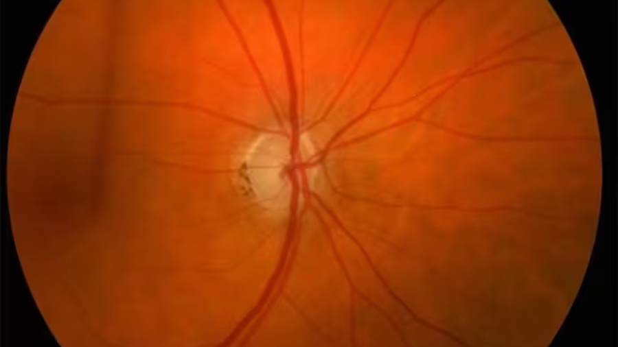 Descubren un ‘equipo de limpieza’ en el ojo que podría ayudar a prevenir la ceguera